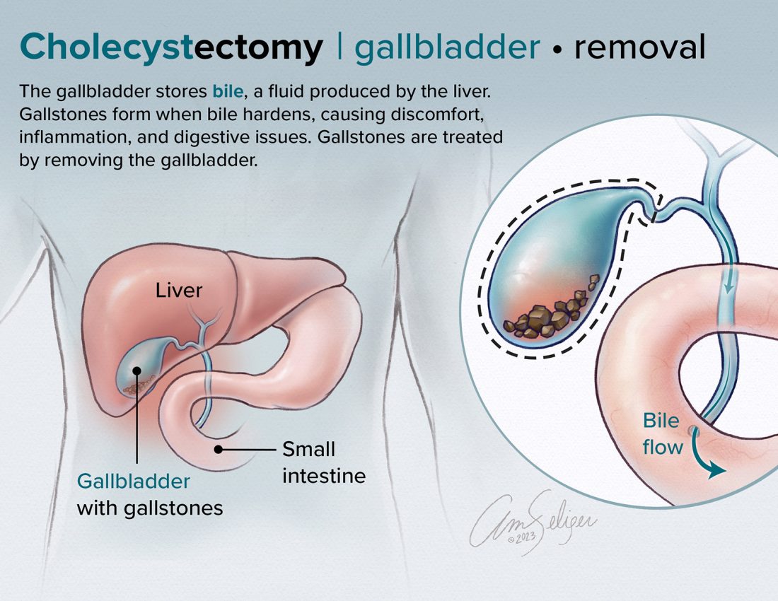 Cholecystectomy Patient Education