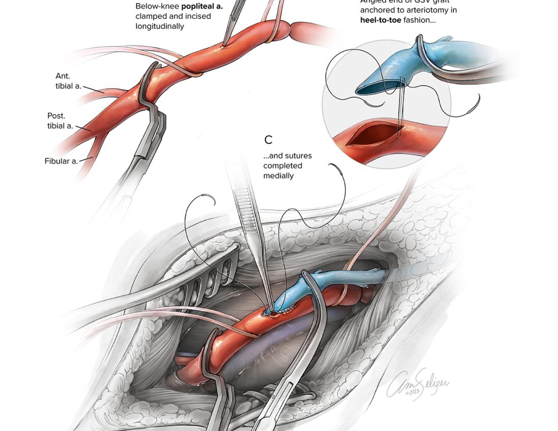 Popliteal Artery Bypass